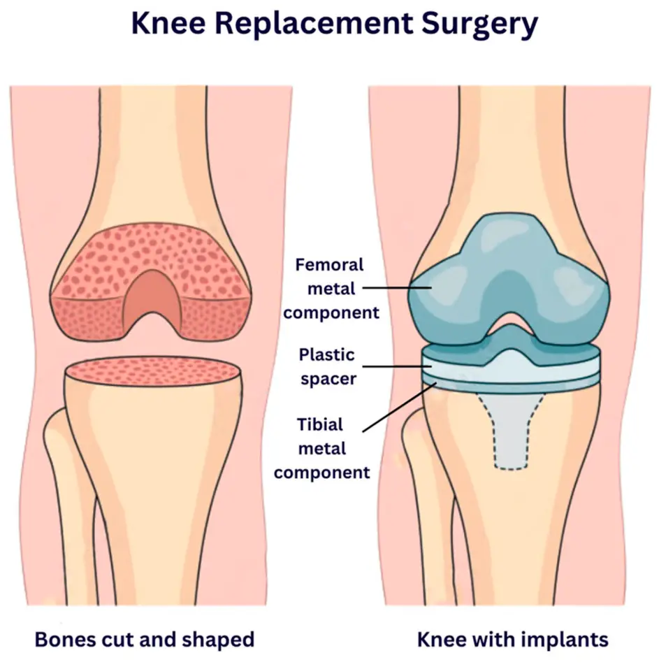 Knee Replacement Surgery